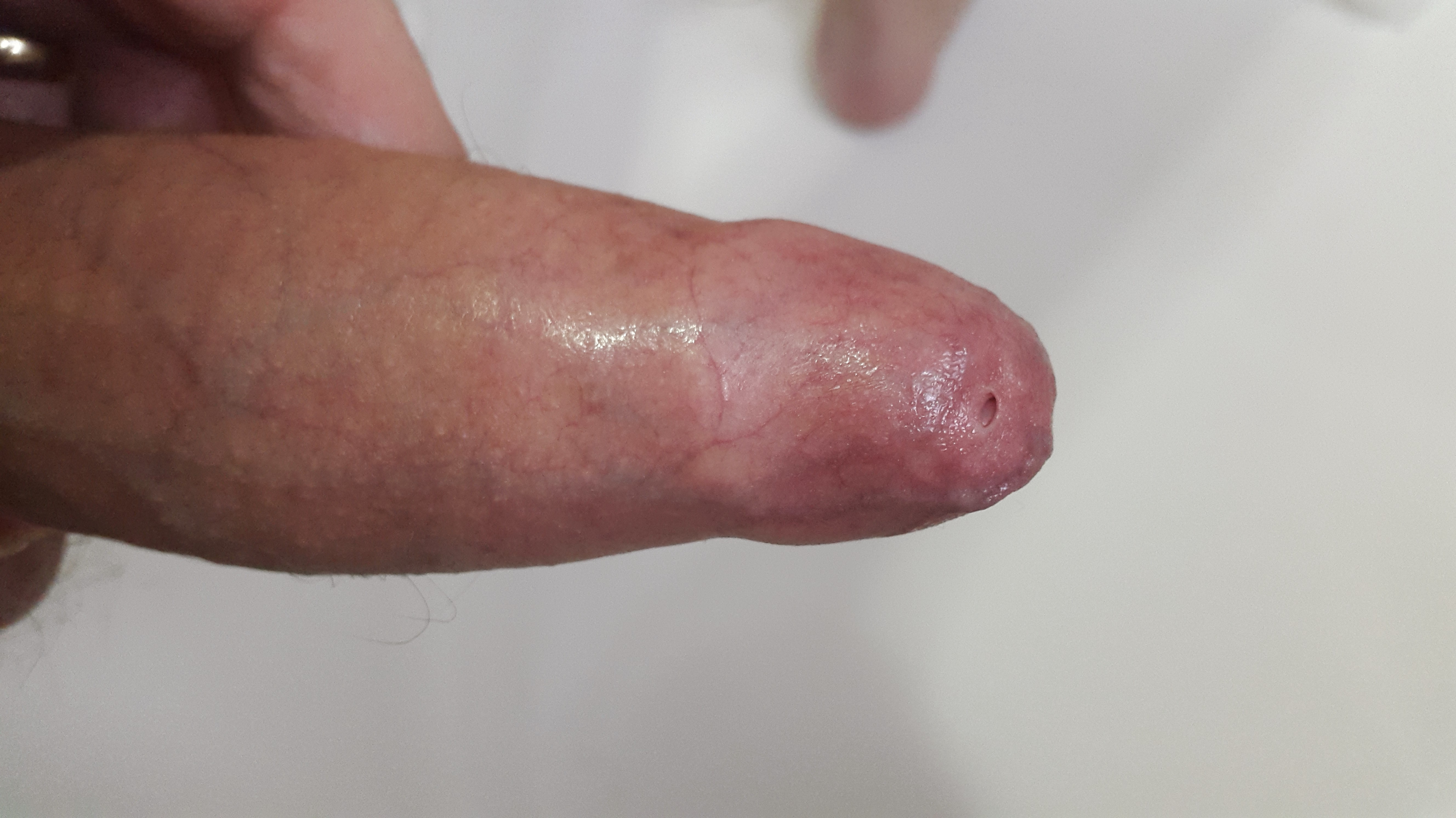 erect penis with severe pinhole phimosis