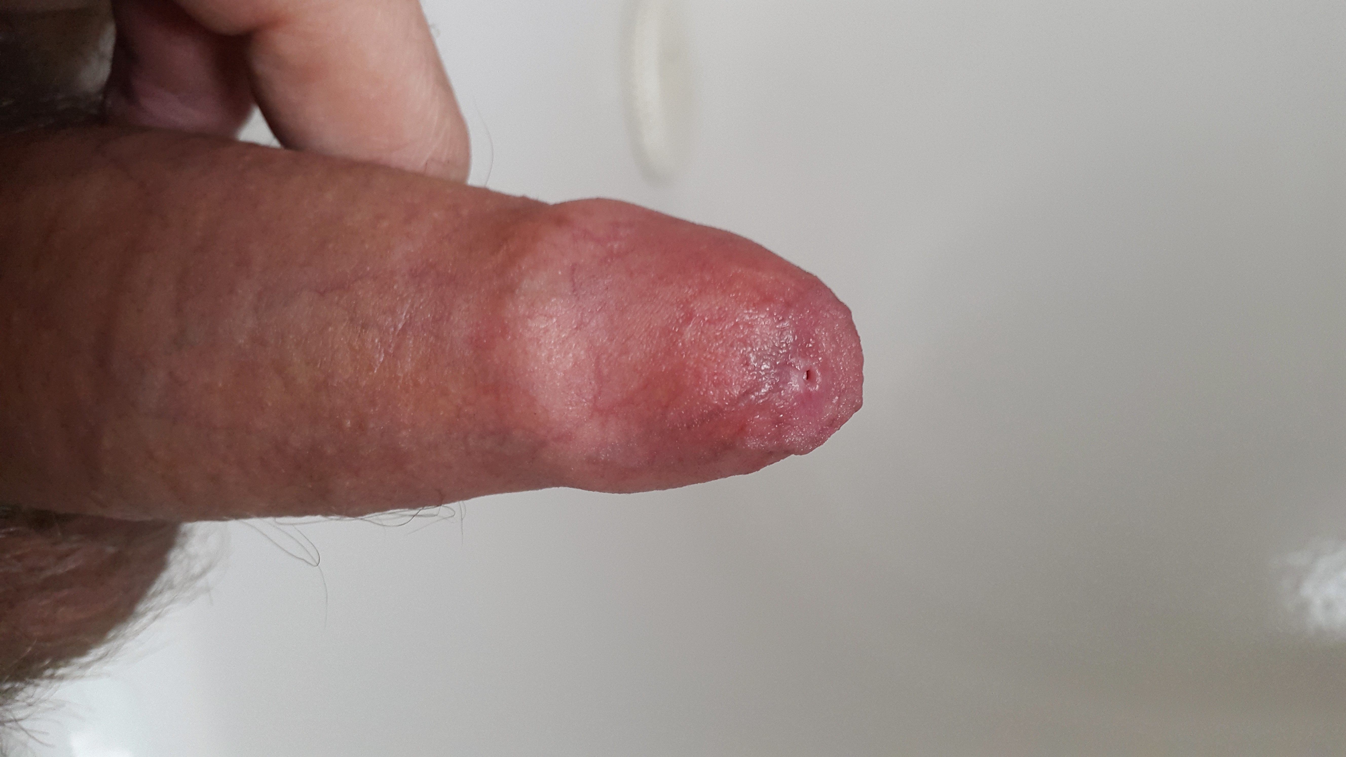 Erect penis with pinhole phimosis.