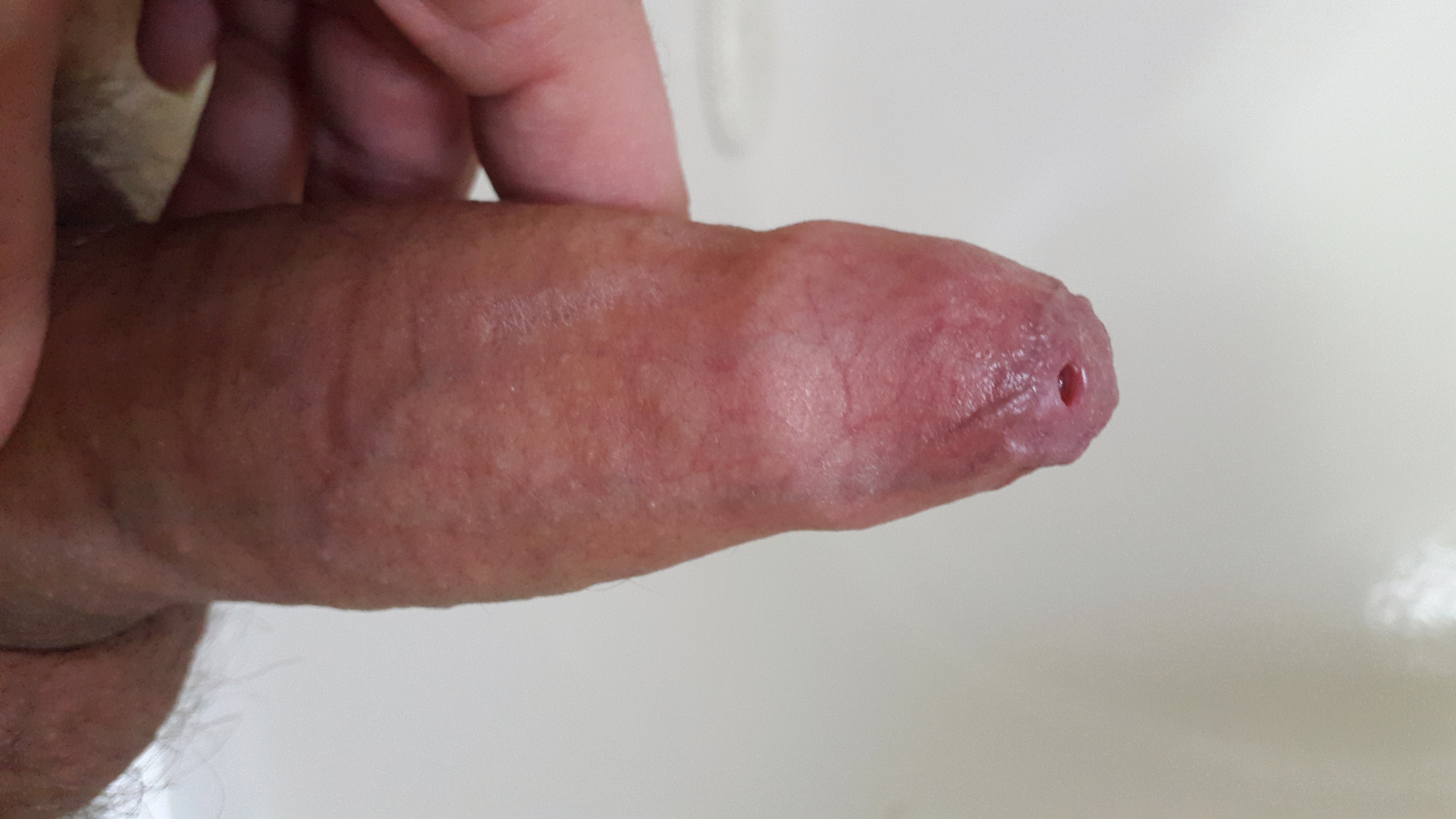 Penis with phimosis after stretching