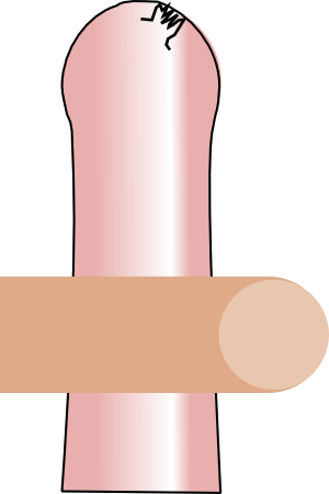 Phimosis with an acroposthion