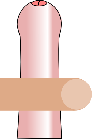 Phimosis with very tight foreskin and little retraction possible