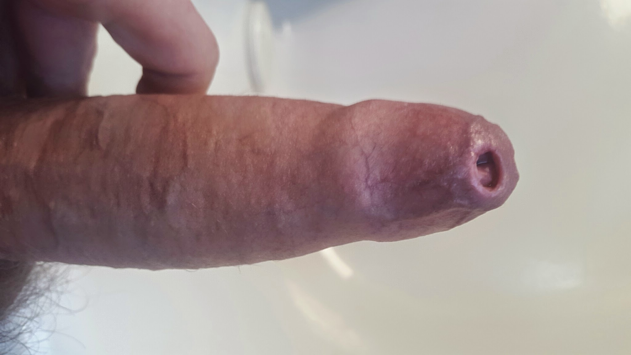 Penis with phimosis