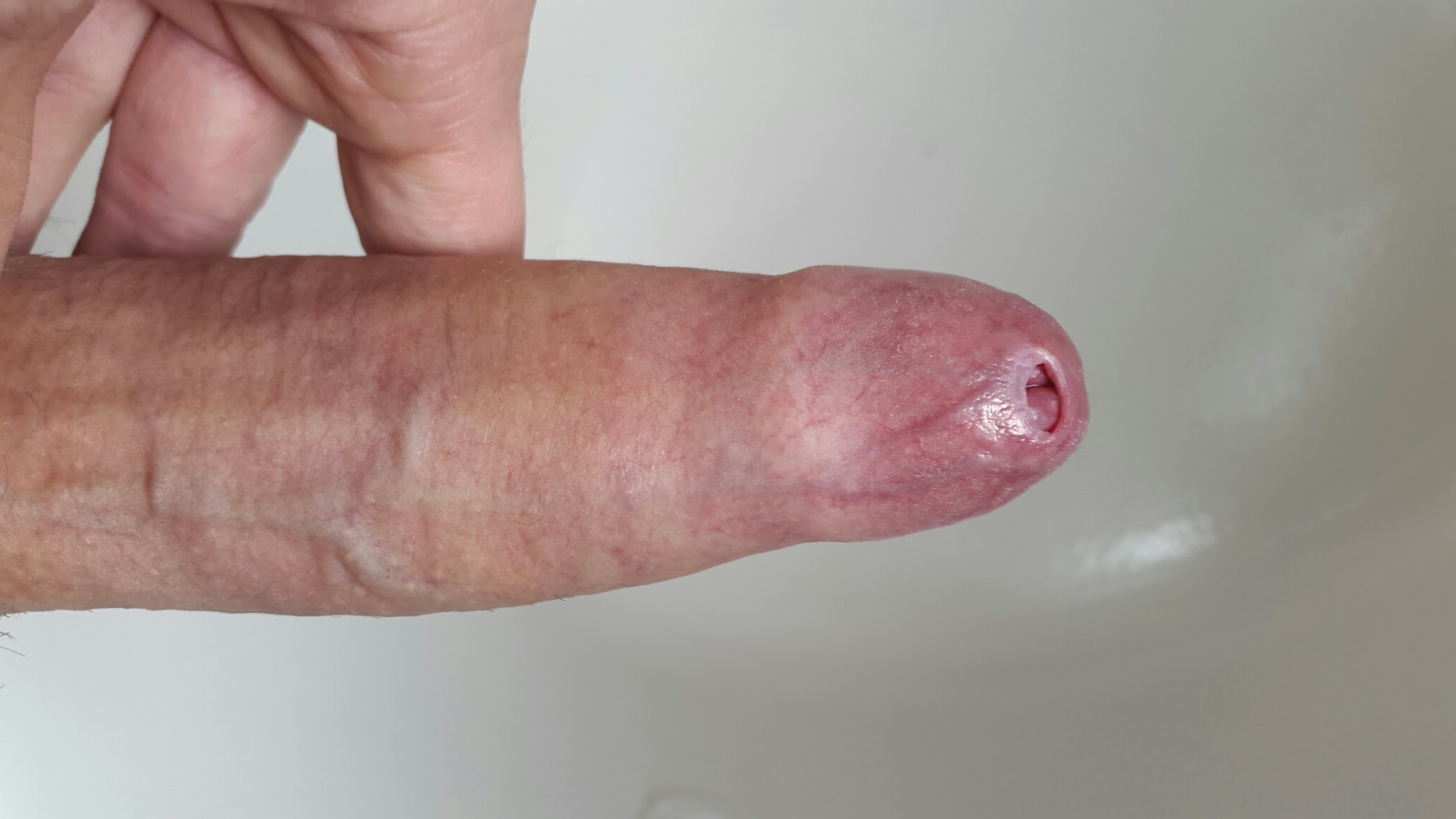 Penis with phimosis