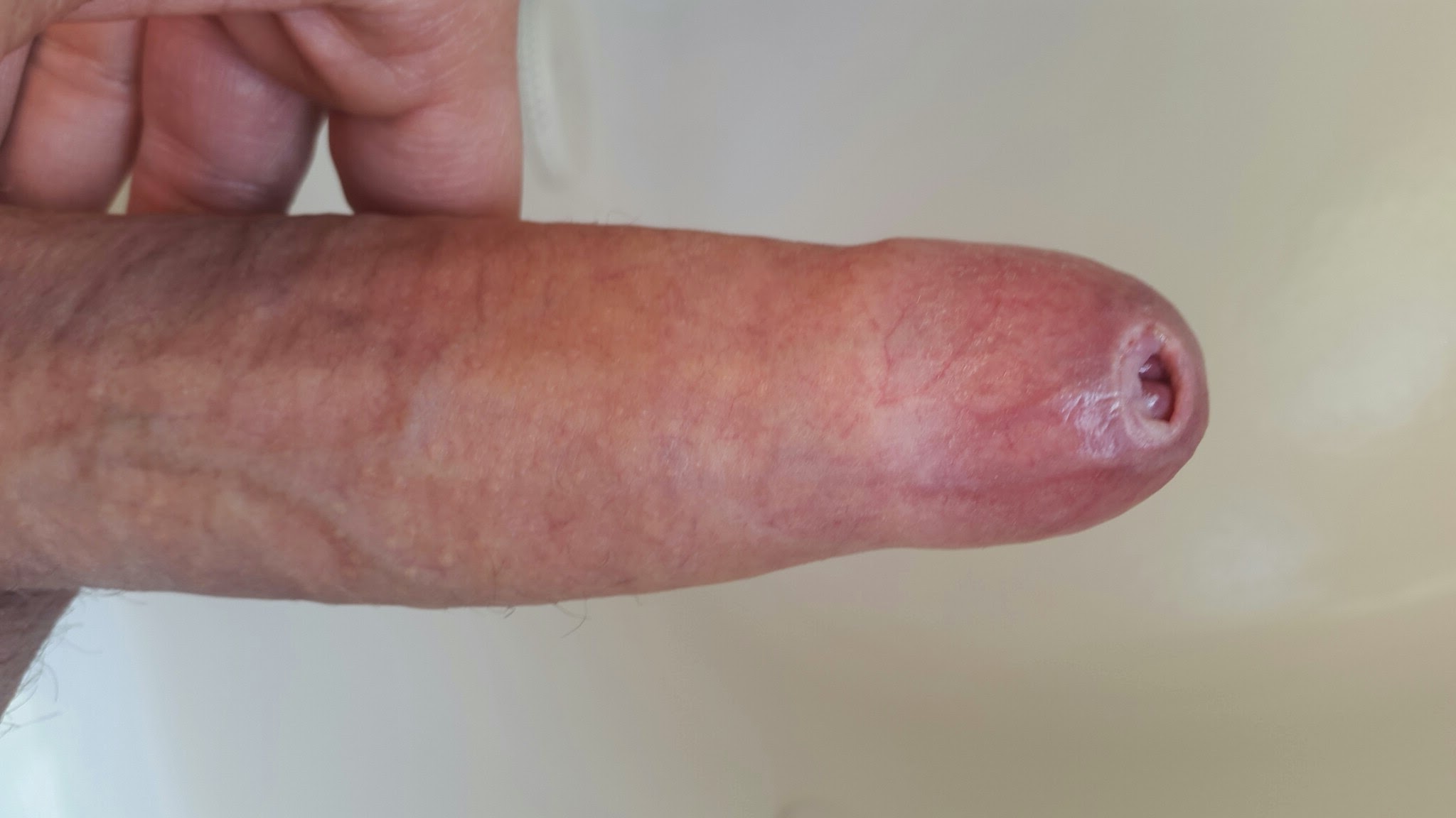 Penis with phimosis