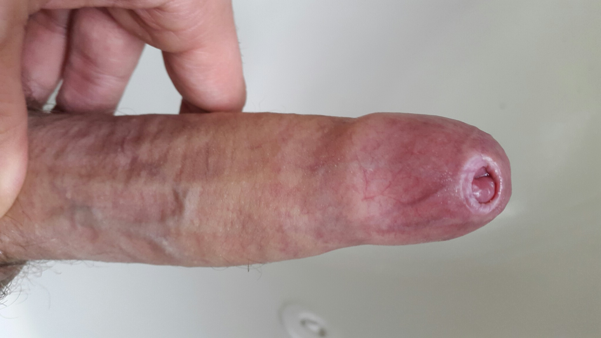 Penis with phimosis