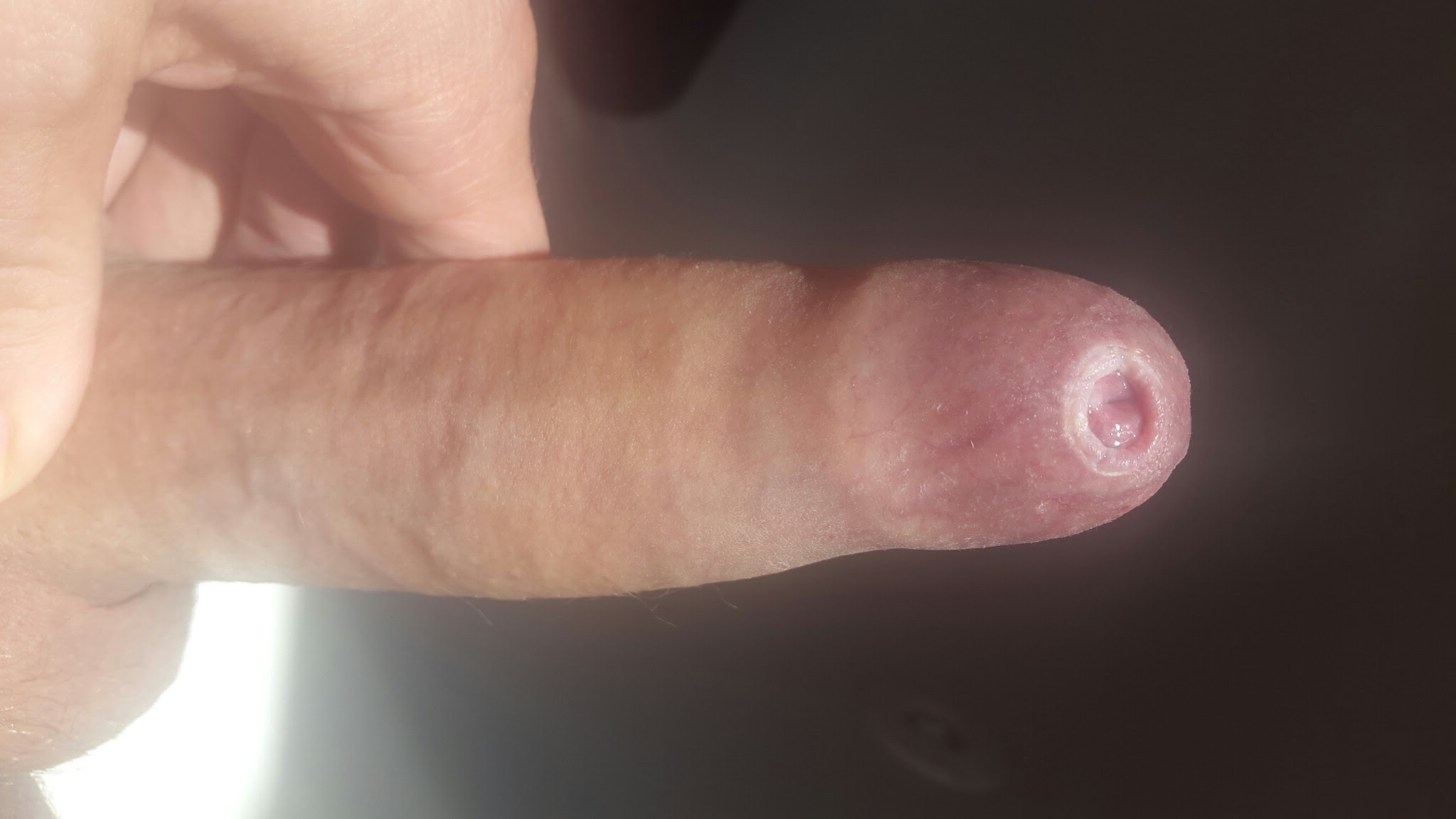 Penis with phimosis