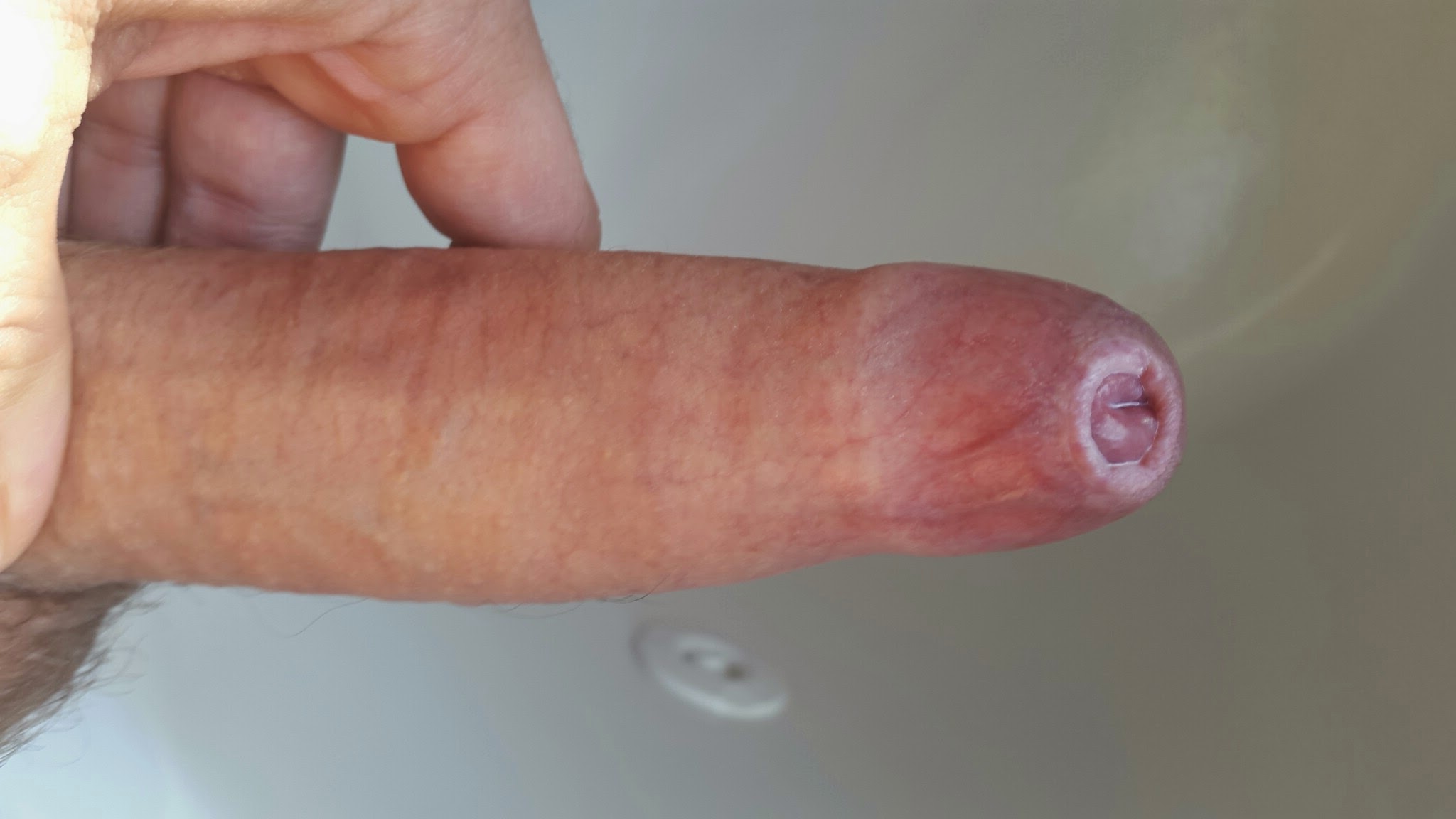Penis with phimosis.