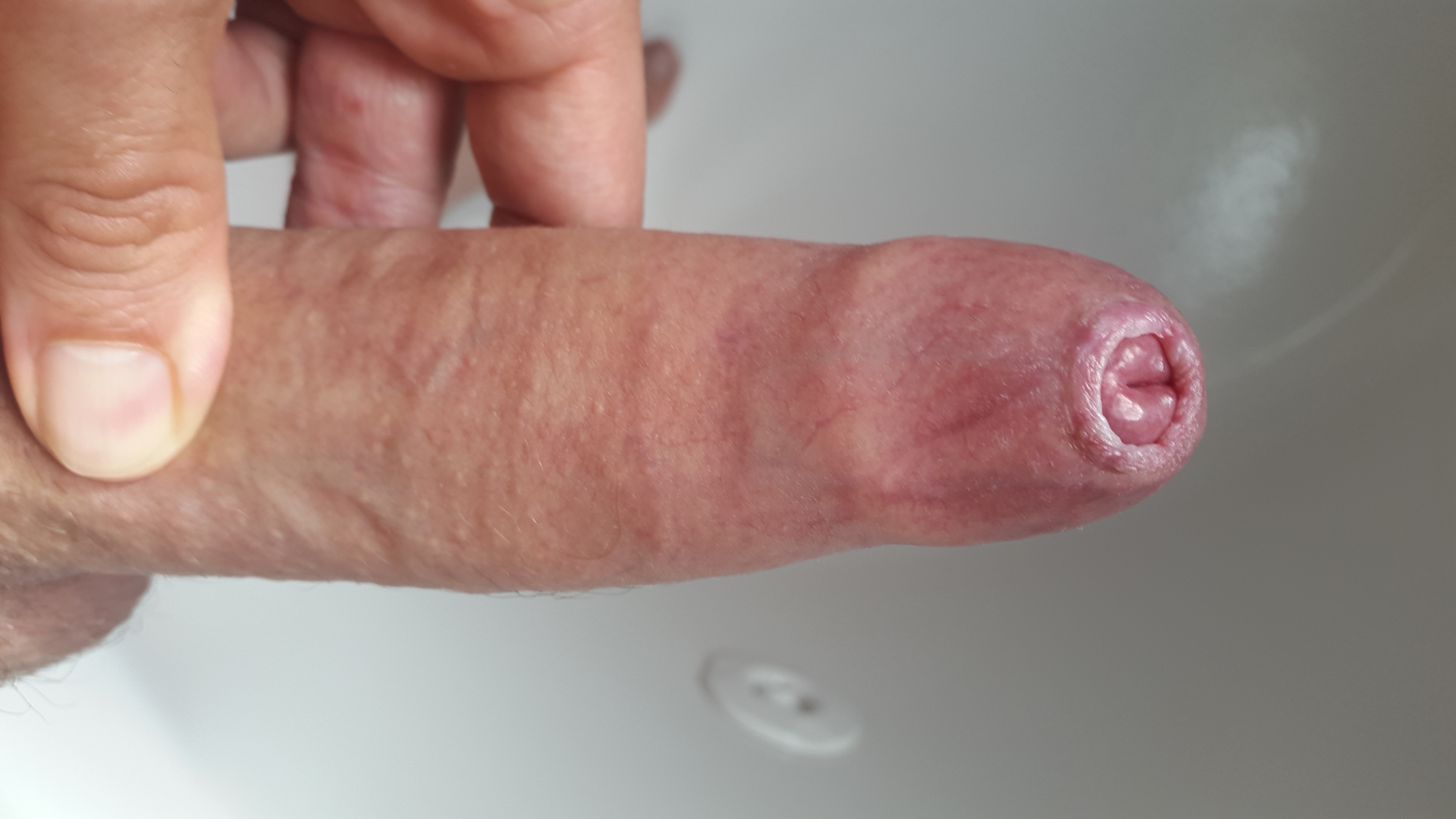 Penis with phimosis