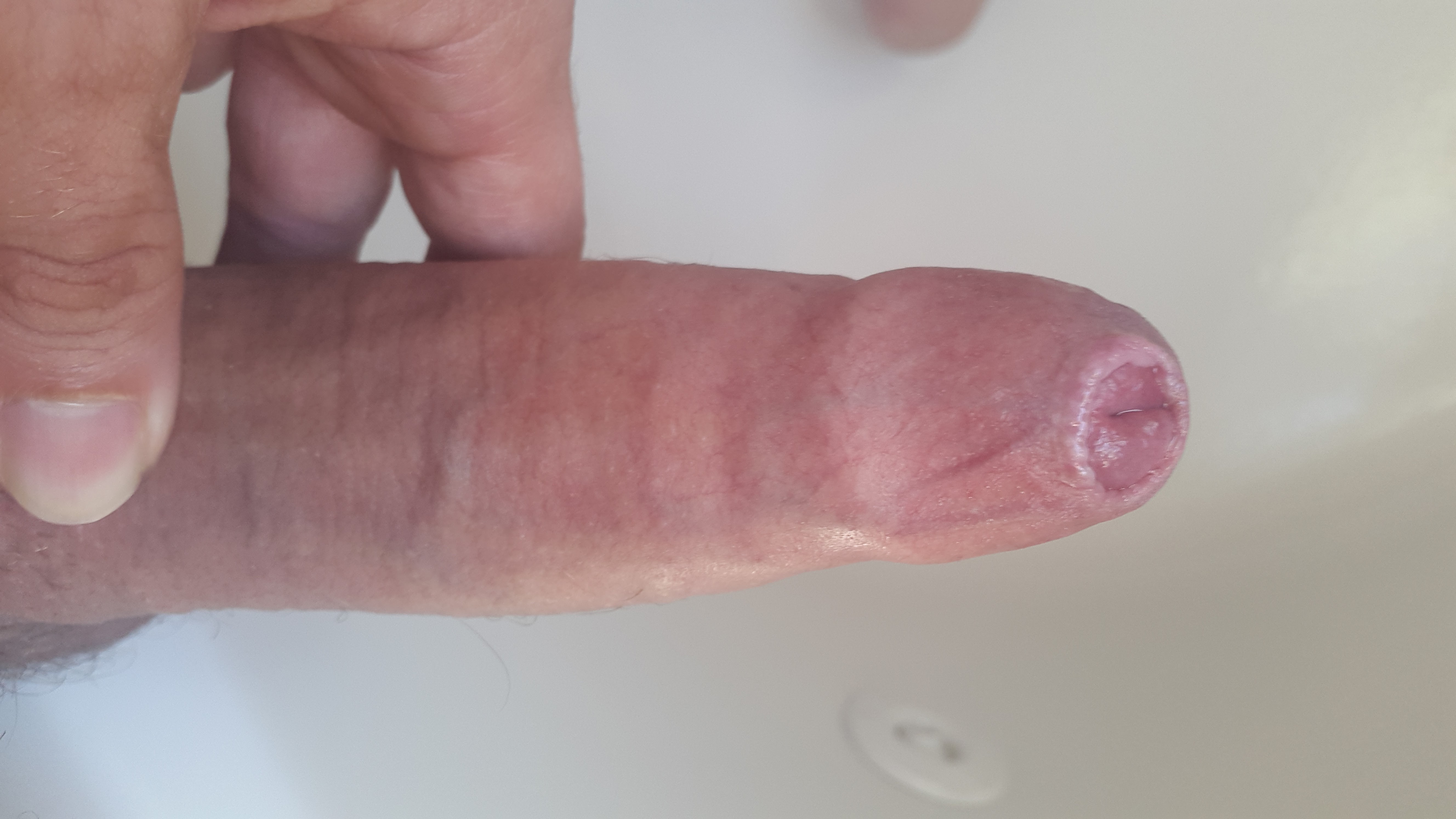 Penis with phimosis