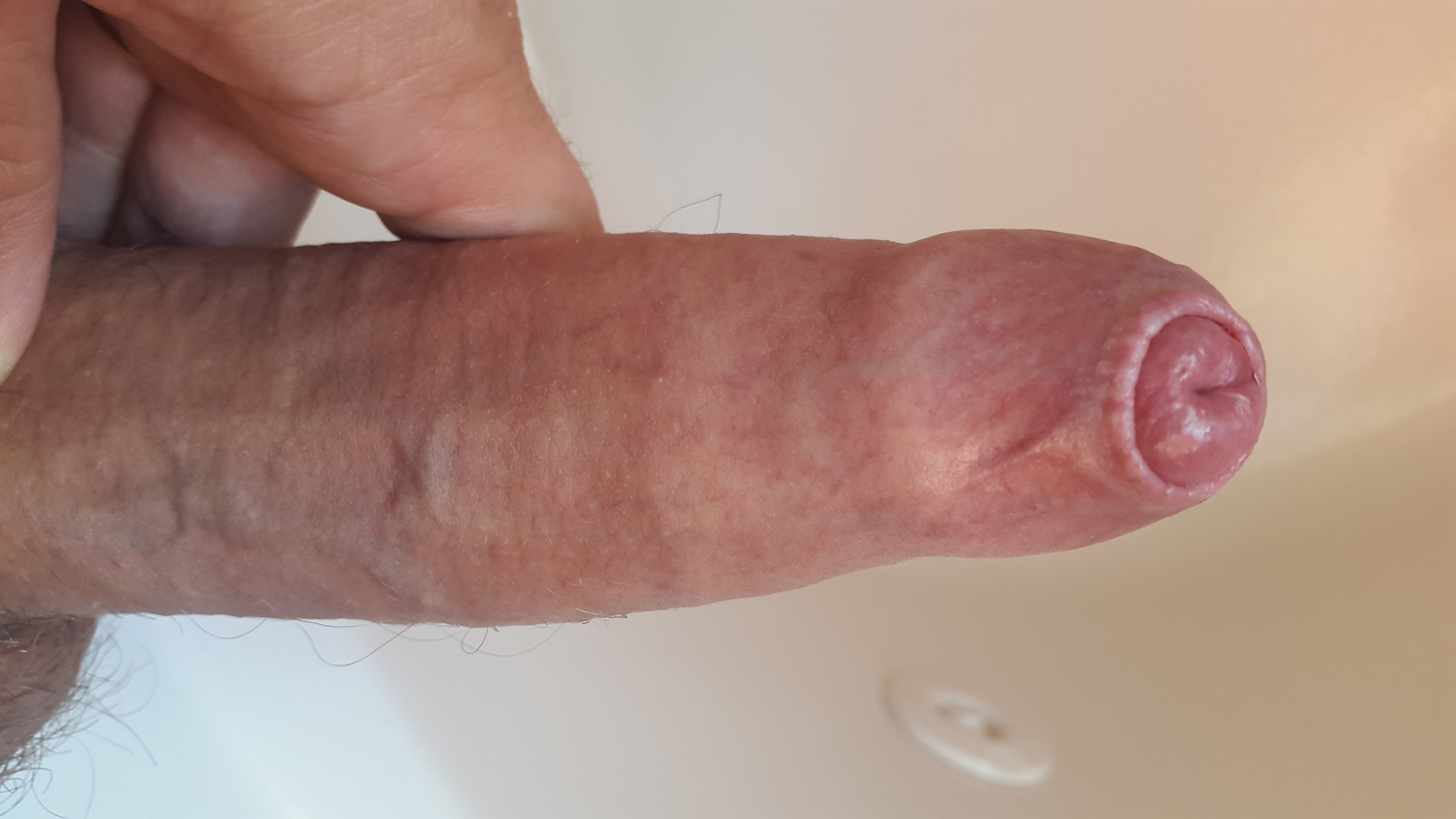 Penis with phimosis