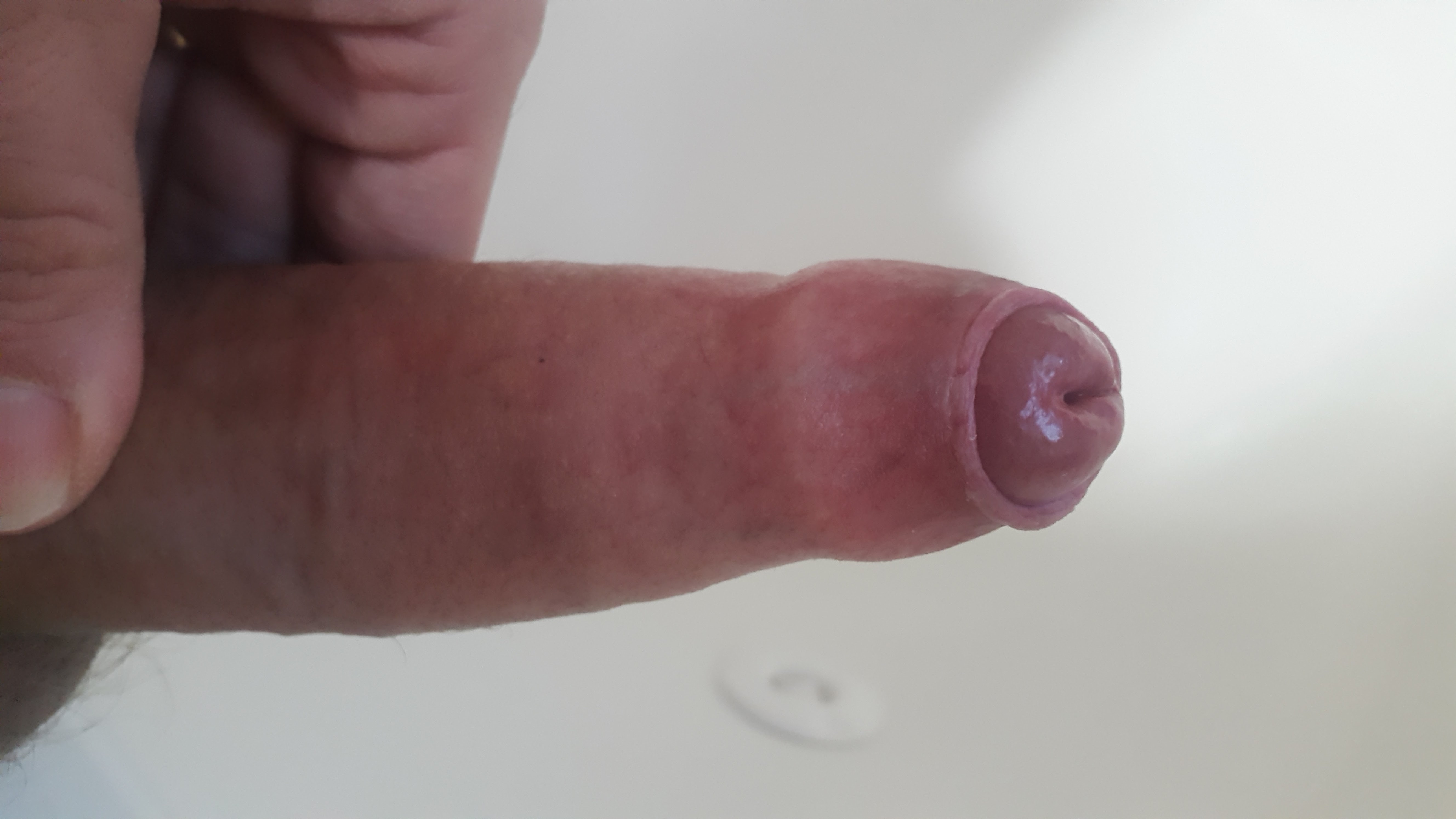 Penis with phimosis