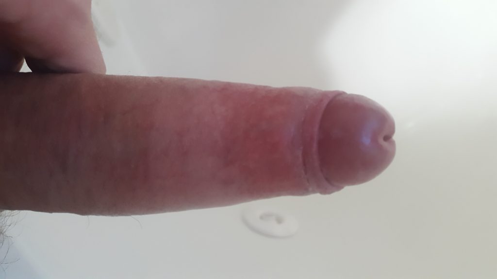 Penis with phimosis