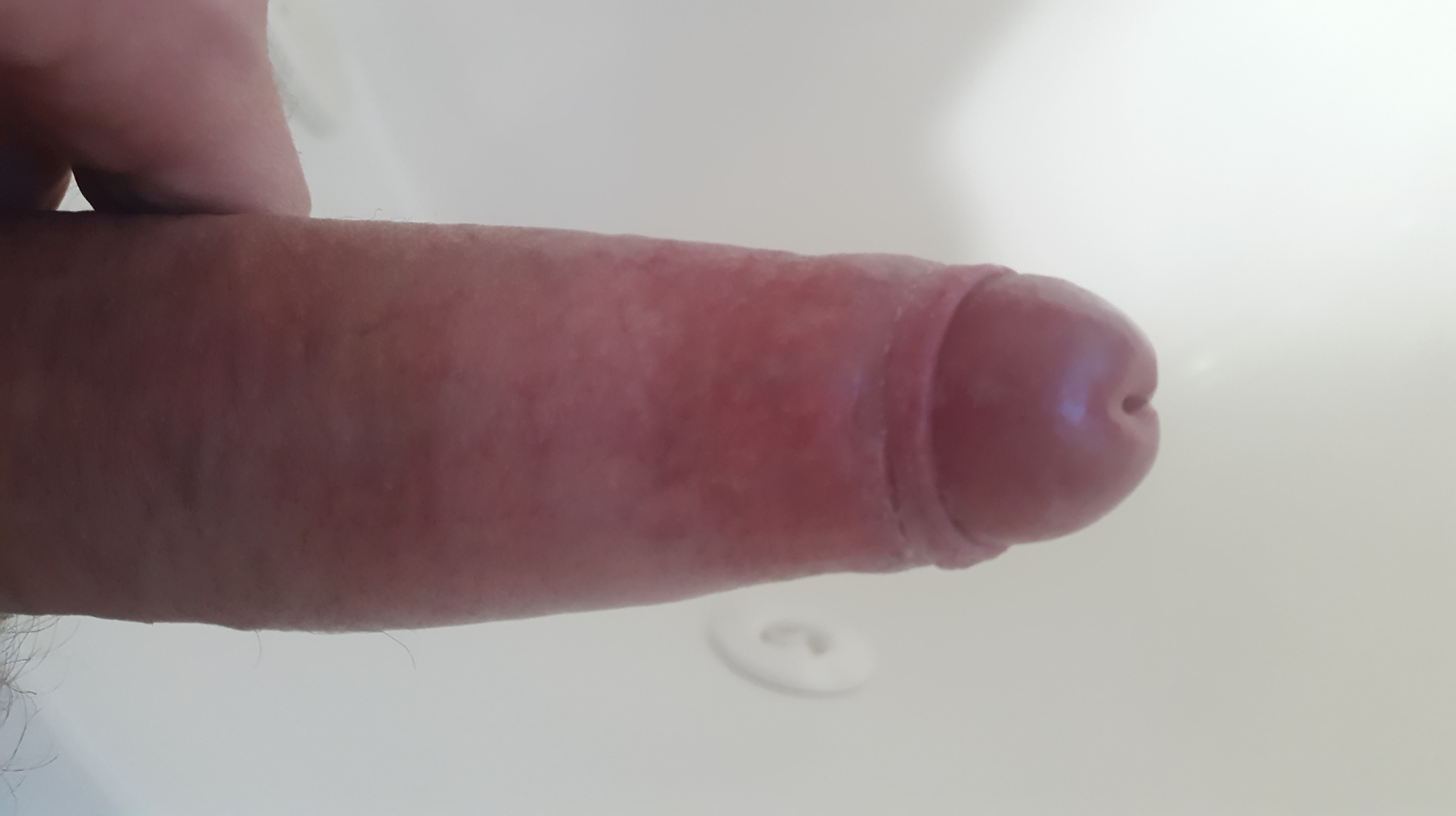 Penis with phimosis